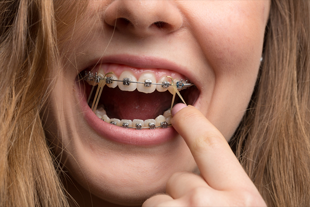 Orthodontics Rubber Bands