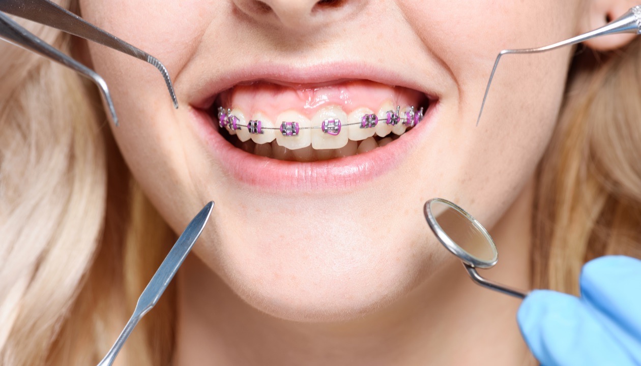 Close-up of woman with adult braces during dental checkup in Mansfield, TX