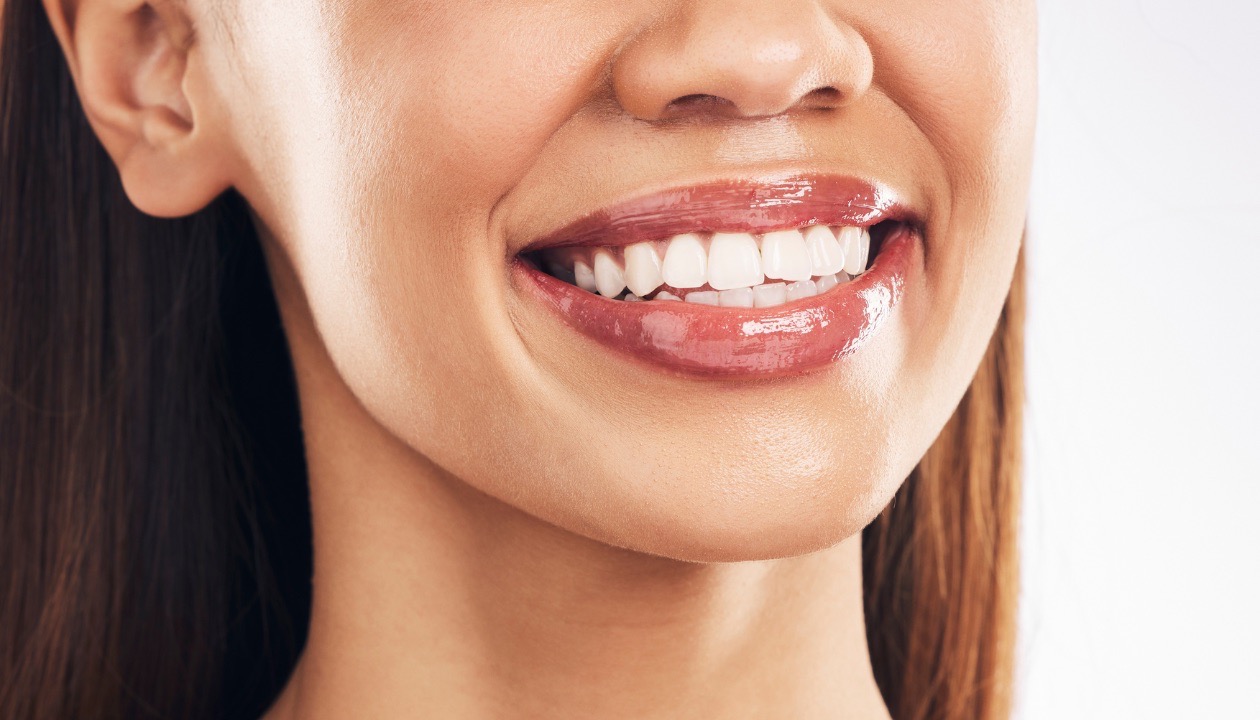 Close-up of woman with braces behind teeth from Mansfield orthodontist