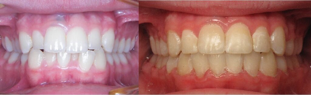 Before and after teeth alignment by orthodontist in Mansfield, TX