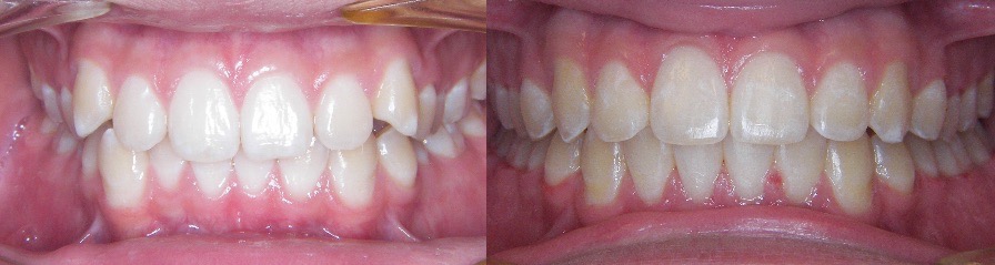 Orthodontic improvement of bite and spacing in Mansfield, TX