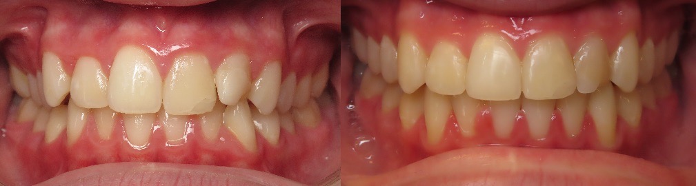 Teeth alignment before and after treatment in Mansfield, TX