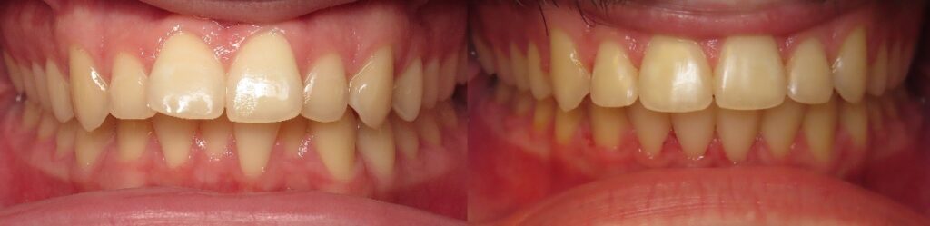 Smile transformation with orthodontic care in Mansfield, TX