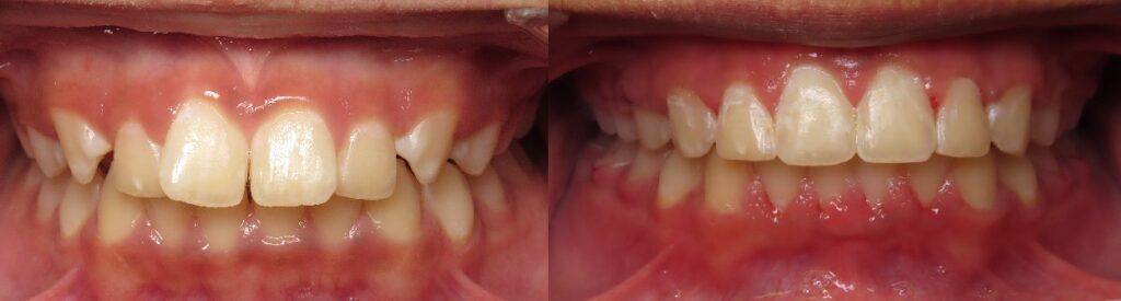 Before and after dental correction in Mansfield, TX